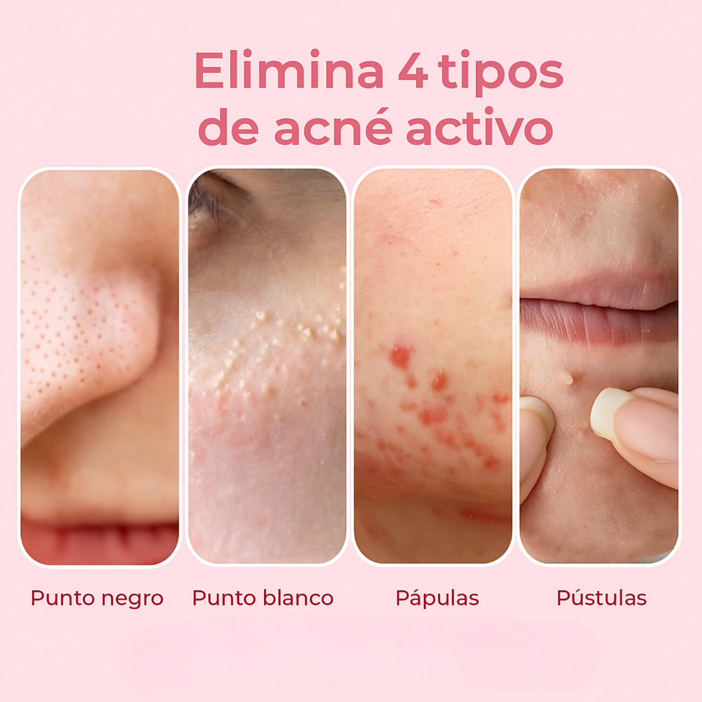 AcneXpress™ – Elimina granos y manchas en solo 2 días  👉 Deja de gastar dinero en productos que no sirven