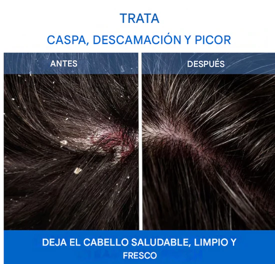 🫧SHAMPOO NAPPORI -Adiós Caspa, Mal Olor y Picazón en 3 Aplicaciones