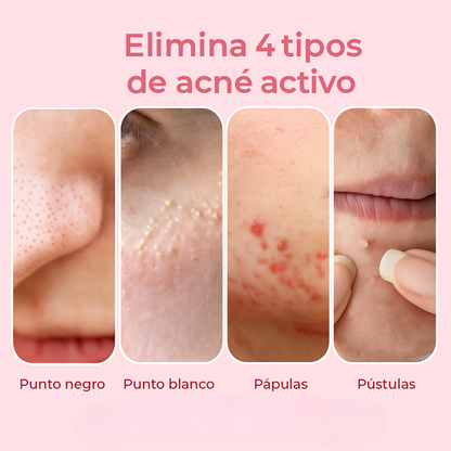AcneXpress™ – Elimina granos y manchas en solo 2 días  👉 Deja de gastar dinero en productos que no sirven