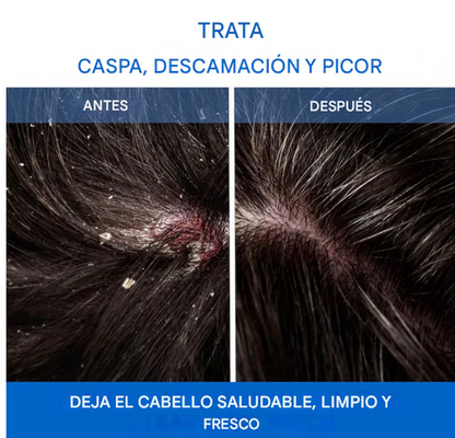 🫧SHAMPOO NAPPORI -Adiós Caspa, Mal Olor y Picazón en 3 Aplicaciones